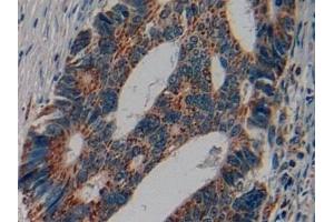 Detection of CRF in Human Colorectal cancer Tissue using Polyclonal Antibody to Corticotropin Releasing Factor (CRF)