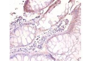 Immunohistochemistry of paraffin-embedded human colorectal carcinoma using VAMP7 / SYBL1 / T1 VAMP antibody at dilution of 1:100. (VAMP7 anticorps  (HRP))