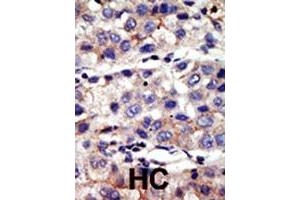Formalin-fixed and paraffin-embedded human hepatocellular carcinoma tissue reacted with CBX4 polyclonal antibody  , which was peroxidase-conjugated to the secondary antibody, followed by AEC staining. (CBX4 anticorps  (N-Term))