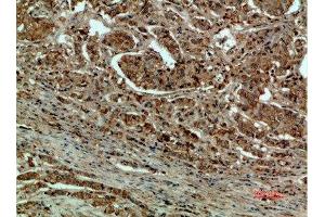 Immunohistochemical analysis of paraffin-embedded human-breast-cancer, antibody was diluted at 1:200
