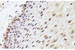 Immunohistochemistry of paraffin-embedded Human esophageal using MLF2 Polyclonal Antibody at dilution of 1:100 (40x lens). (MLF2 anticorps)