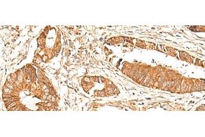 Immunohistochemistry of paraffin-embedded Human colorectal cancer tissue using BAG3 Polyclonal Antibody at dilution of 1:35(x200) (BAG3 anticorps)
