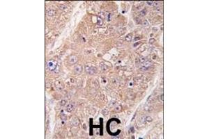 Formalin-fixed and paraffin-embedded human hepatocarcinoma tissue reacted with hUVRAG (Center) (ABIN388587 and ABIN2849985) , which was peroxidase-conjugated to the secondary antibody, followed by DAB staining. (UVRAG anticorps  (AA 366-398))