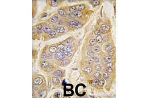 Formalin-fixed and paraffin-embedded human breast carcinoma tissue reacted with NANOS1 polyclonal antibody  , which was peroxidase-conjugated to the secondary antibody, followed by DAB staining. (Nanos Homolog 1 anticorps  (C-Term))