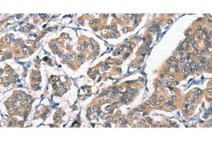 Immunohistochemistry of paraffin-embedded Human breast cancer tissue using HGF Polyclonal Antibody at dilution 1:65 (HGF anticorps)
