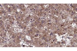 ABIN6273967 at 1/100 staining Human liver cancer tissue by IHC-P. (OR1G1 anticorps  (Internal Region))