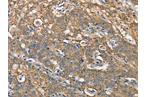 The image on the left is immunohistochemistry of paraffin-embedded Human gastric cancer tissue using ABIN7190368(CSMD1 Antibody) at dilution 1/40, on the right is treated with synthetic peptide. (CSMD1 anticorps)