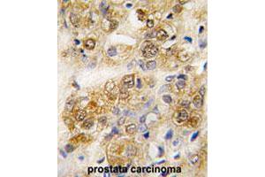 Formalin-fixed and paraffin-embedded human prostate carcinoma tissue reacted with HSPA5 polyclonal antibody  , which was peroxidase-conjugated to the secondary antibody, followed by DAB staining.