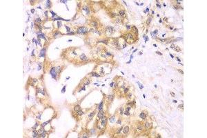 Immunohistochemistry of paraffin-embedded Human liver cancer using ACADS Polyclonal Antibody at dilution of 1:100 (40x lens). (ACADS anticorps)