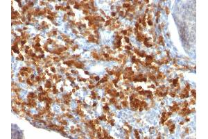 Formalin-fixed, paraffin-embedded human Lymphoma stained with CD79a Monoclonal Antibody (IGA/515). (CD79a anticorps)