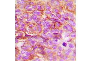 Immunohistochemical analysis of STEAP3 staining in human breast cancer formalin fixed paraffin embedded tissue section.