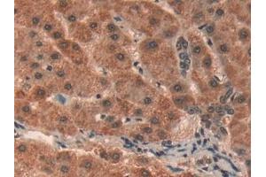 Detection of PHB in Human Liver cancer Tissue using Polyclonal Antibody to Prohibitin (PHB)