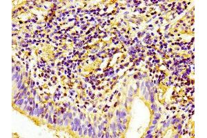 IHC image of ABIN7147154 diluted at 1:100 and staining in paraffin-embedded human lung cancer performed on a Leica BondTM system. (CD31 anticorps  (AA 28-315))