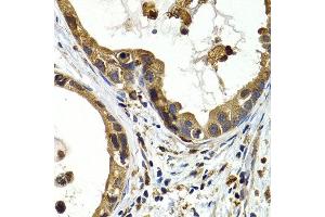 Immunohistochemistry of paraffin-embedded human stomach cancer using CTSS antibody at dilution of 1:200 (400x lens). (Cathepsin S anticorps)