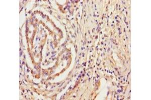 Immunohistochemistry of paraffin-embedded human pancreatic cancer using ABIN7166456 at dilution of 1:100 (TPST2 anticorps  (AA 26-377))