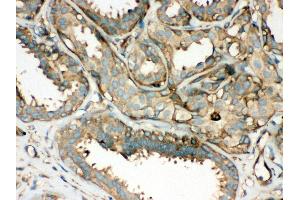Anti- ROCK2 Picoband antibody,IHC(P) IHC(P): Human Mammary Cancer Tissue (ROCK2 anticorps  (AA 652-923))