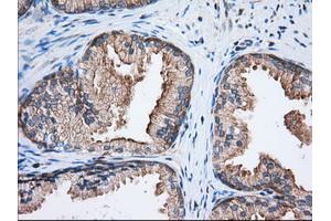 Immunohistochemical staining of paraffin-embedded Adenocarcinoma of Human ovary tissue using anti-EIF2S1 mouse monoclonal antibody. (EIF2S1 anticorps)