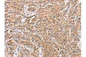 The image on the left is immunohistochemistry of paraffin-embedded Human prostate cancer tissue using ABIN7131608(WNT11 Antibody) at dilution 1/20, on the right is treated with fusion protein.