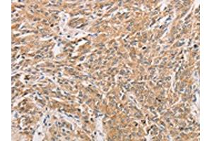 The image on the left is immunohistochemistry of paraffin-embedded Human prostate cancer tissue using ABIN7131608(WNT11 Antibody) at dilution 1/20, on the right is treated with fusion protein. (WNT11 anticorps)