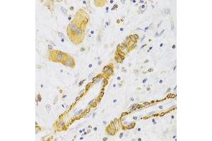 Immunohistochemistry of paraffin-embedded human liver cancer using KIF1B Antibody (ABIN5973994) at dilution of 1/100 (40x lens). (KIF1B anticorps)