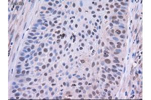 Immunohistochemical staining of paraffin-embedded Adenocarcinoma of colon using anti-EpCAM (ABIN2452541) mouse monoclonal antibody. (EpCAM anticorps  (AA 24-265))