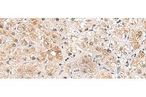 Immunohistochemistry of paraffin-embedded Human liver cancer tissue using RTKN2 Polyclonal Antibody at dilution of 1:75(x200) (RTKN2 anticorps)