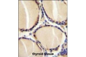 CALCA Antibody (Center) (ABIN655071 and ABIN2844701) immunohistochemistry analysis in formalin fixed and paraffin embedded human thyroid tissue followed by peroxidase conjugation of the secondary antibody and DAB staining.