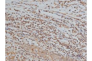 ABIN6267039 at 1/200 staining human breast cancer tissue sections by IHC-P. (Histone 3 anticorps)