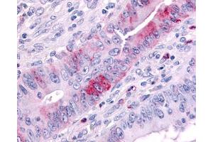 Anti-MAP3K9 antibody IHC of human colon cancer. (MAP3K9 anticorps  (Internal Region))