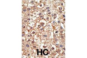 Formalin-fixed and paraffin-embedded human hepatocellular carcinoma tissue reacted with the PIAS4 polyclonal antibody  , which was peroxidase-conjugated to the secondary antibody, followed by DAB staining. (PIAS4 anticorps  (N-Term))