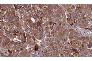ABIN6273847 at 1/100 staining Human liver cancer tissue by IHC-P. (OR51J1 anticorps)