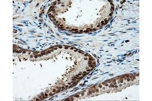 Immunohistochemical staining of paraffin-embedded Carcinoma of liver tissue using anti-LIPG mouse monoclonal antibody. (LIPG anticorps)
