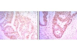 Immunohistochemical analysis of paraffin-embedded colon cancer tissues (left) and ovary cancer tissues (right) using THAP11 mouse mAb with DAB staining.