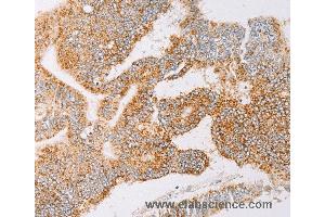 Immunohistochemistry of Human lung cancer using YARS2 Polyclonal Antibody at dilution of 1:30 (YARS2 anticorps)