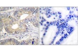 Immunohistochemistry analysis of paraffin-embedded human colon carcinoma tissue, using Somatostatin Antibody.