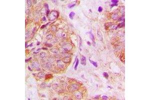 Immunohistochemical analysis of GSPT1 staining in human breast cancer formalin fixed paraffin embedded tissue section. (GSPT1 anticorps)