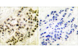 Peptide - +Immunohistochemical analysis of paraffin-embedded human breast carcinoma tissue using Cyclin B1 (Ab-126) antibody (#BOO68). (Cyclin B1 anticorps  (Ser126))