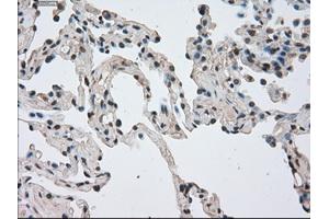 Immunohistochemical staining of paraffin-embedded Adenocarcinoma of breast tissue using anti-NEK6 mouse monoclonal antibody. (NEK6 anticorps)