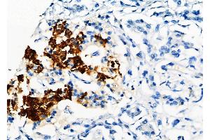 ABIN6261692 and ABIN6277568 at 1/100 staining Human pancreatic cancer and adjacent nomal tissues by IHC-P. (FBP1 anticorps  (Internal Region))