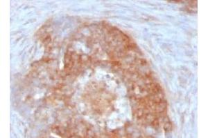 Formalin-fixed, paraffin-embedded human ovarian carcinoma stained with Fascin antibody (FSCN1/417) (Fascin anticorps)