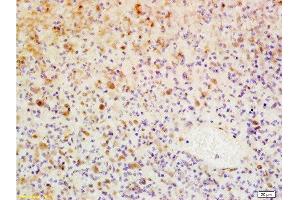 Formalin-fixed and paraffin embedded human glioma tissue labeled with Anti-WIG-1/PAG608 Polyclonal Antibody, Unconjugated  at 1:200, followed by conjugation to the secondary antibody and DAB staining