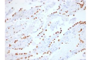 Formalin-fixed, paraffin-embedded human Lung Adenocarcinoma stained with TTF-1 Rabbit Recombinant Monoclonal Antibody (NX2. (Recombinant NKX2-1 anticorps)