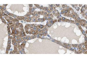 ABIN6269118 at 1/100 staining Human liver cancer tissue by IHC-P. (IGF1R anticorps  (C-Term))