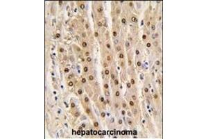 Formalin-fixed and paraffin-embedded human hepatocarcinoma tissue reacted with GDH antibody (N-term), which was peroxidase-conjugated to the secondary antibody, followed by DAB staining. (GAPDH anticorps  (N-Term))