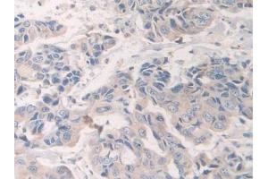 Detection of NCCT in Human Breast cancer Tissue using Polyclonal Antibody to Na-Cl Cotransporter (NCCT)