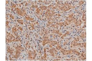 ABIN6267433 at 1/200 staining Human lung cancer tissue sections by IHC-P.