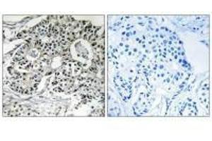 Immunohistochemistry analysis of paraffin-embedded human breast carcinoma tissue using PXMP2 antibody. (PXMP2 anticorps)