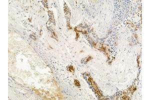 ABIN6262776 and ABIN6266570 at 1/100 staining human breast carcinoma by IHC-P. (KRT17 anticorps  (C-Term))