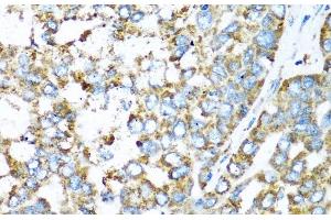 Immunohistochemistry of paraffin-embedded Human liver cancer using COX6A1 Polyclonal Antibody at dilution of 1:100 (40x lens).