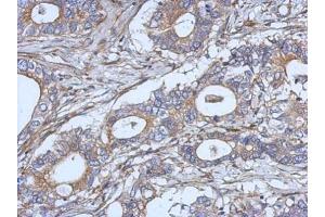 IHC-P Image Immunohistochemical analysis of paraffin-embedded human gastric cancer, using IL2, antibody at 1:500 dilution. (IL-2 anticorps)
